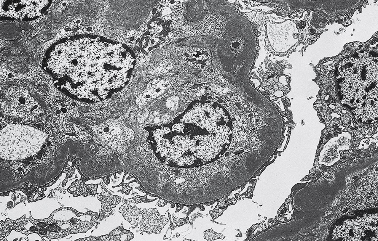 FIG. 3.107, Membranoproliferative glomerulonephritis (MPGN).