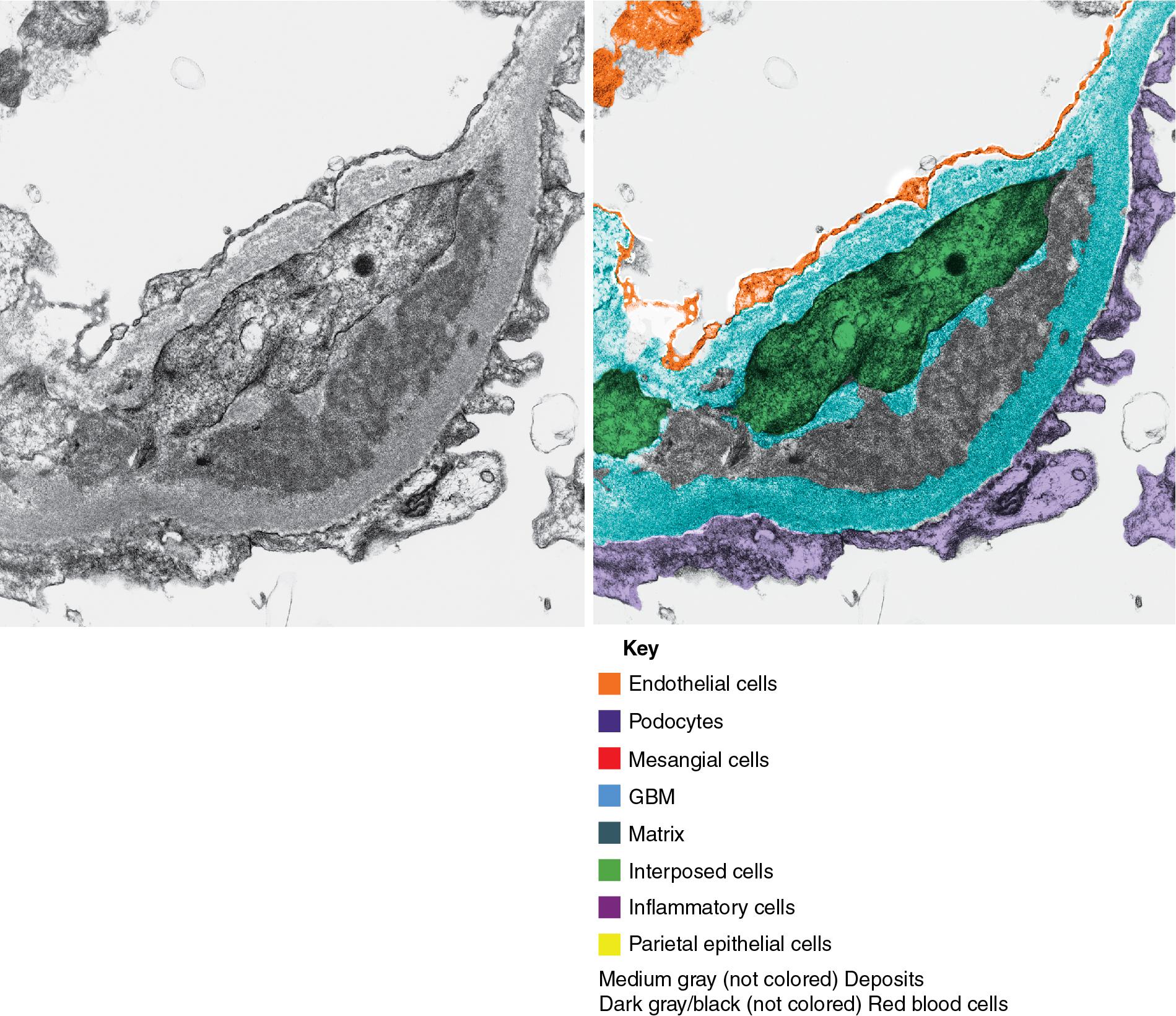 FIG. 3.109, Membranoproliferative glomerulonephritis (MPGN).