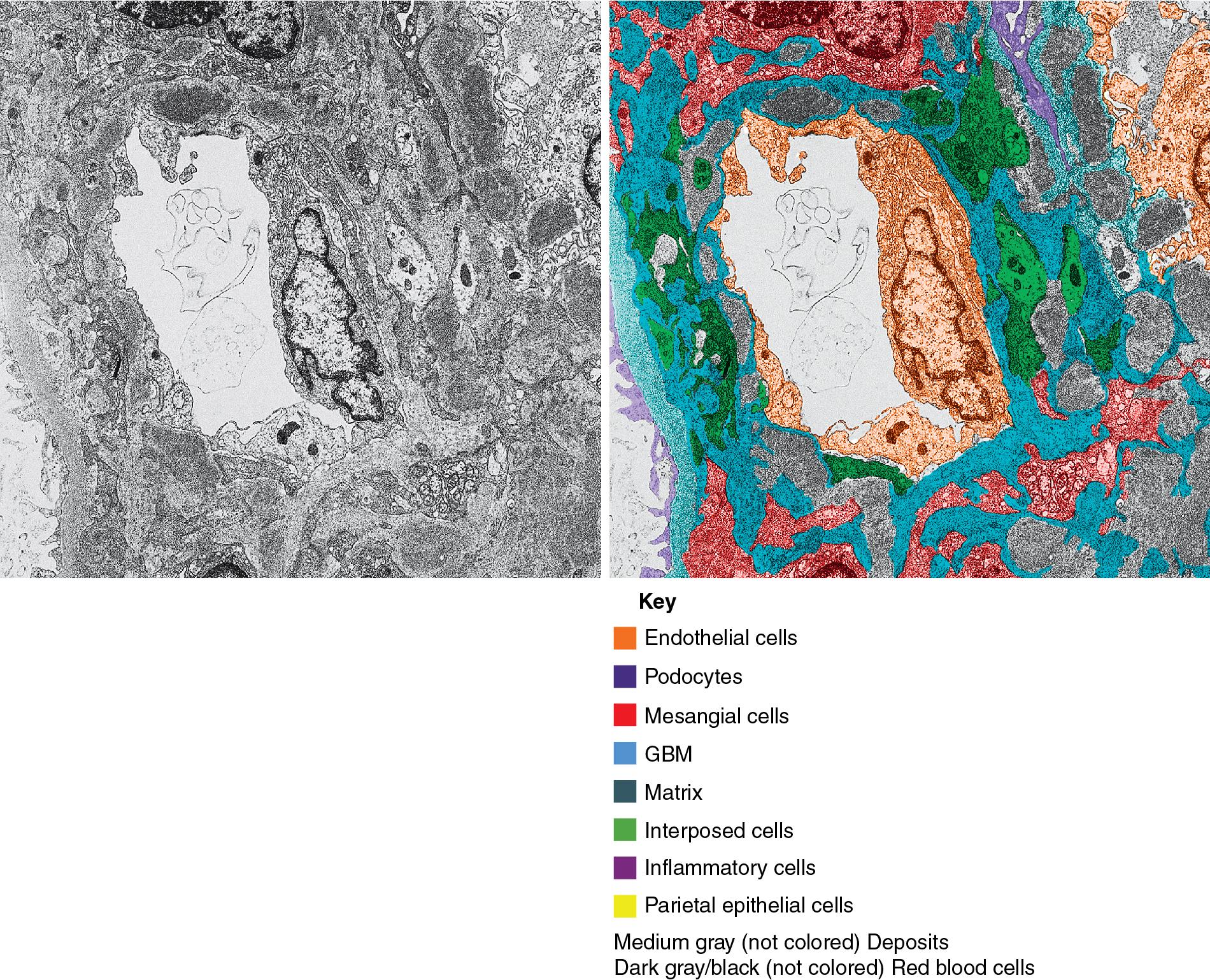 FIG. 3.110, Membranoproliferative glomerulonephritis (MPGN).