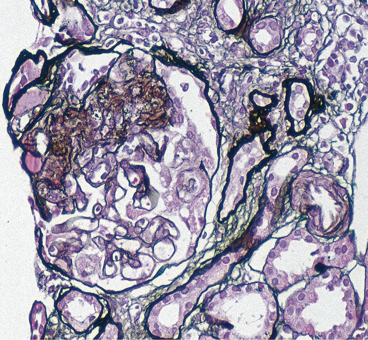 FIG. 3.11, Focal segmental glomerulosclerosis (FSGS).