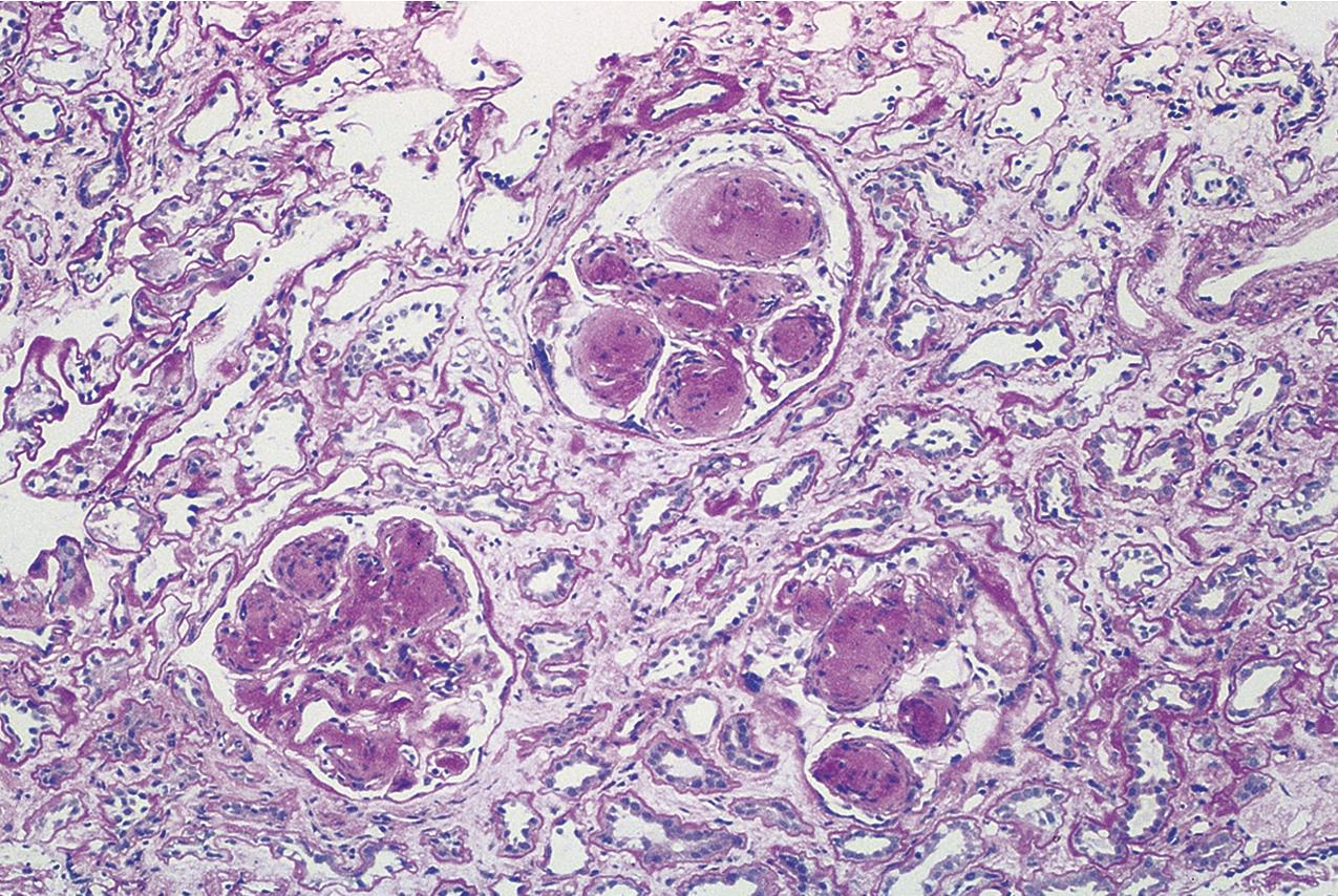 FIG. 3.112, Fibrillary glomerulonephritis.