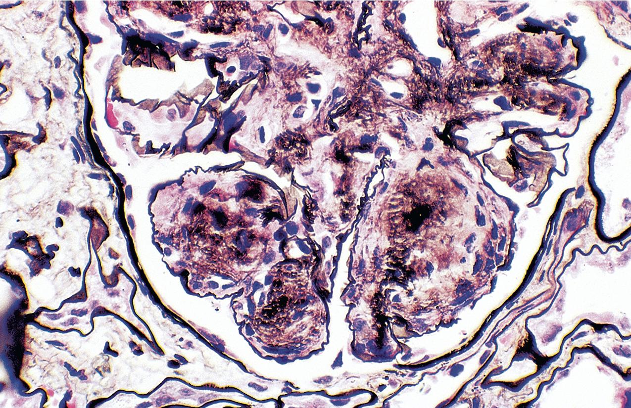 FIG. 3.113, Fibrillary glomerulonephritis.