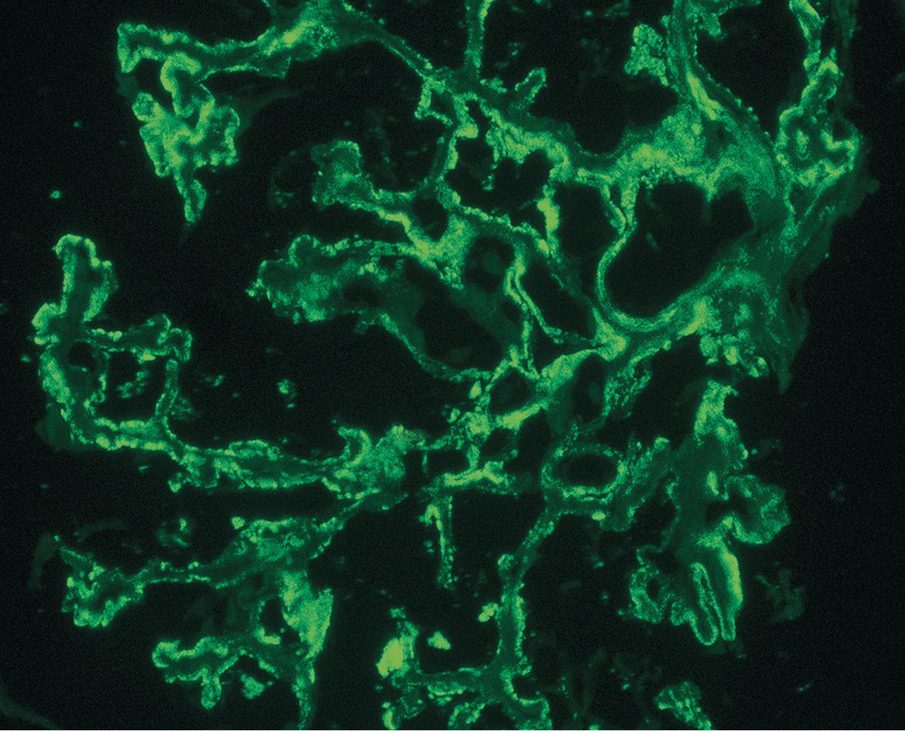 FIG. 3.116, Fibrillary glomerulonephritis may also show a membranous pattern of deposits in some cases, with corresponding coarsely granular peripheral loop deposits, along with coarse mesangial deposits as shown here (anti-IgG immunofluorescence, ×400).
