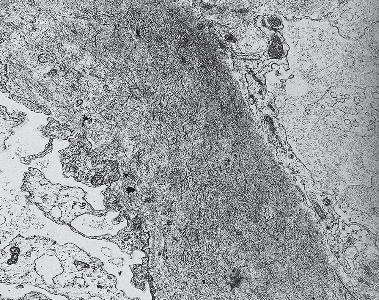 FIG. 3.118, Fibrillary glomerulonephritis.