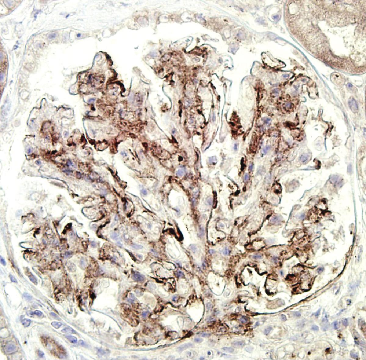 FIG. 3.121, Fibrillary glomerulonephritis.