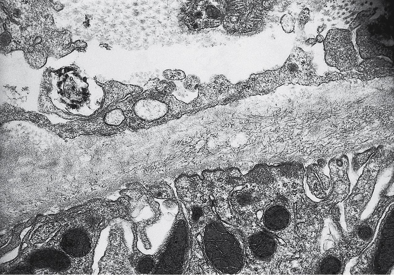 FIG. 3.122, Fibrillary glomerulonephritis.