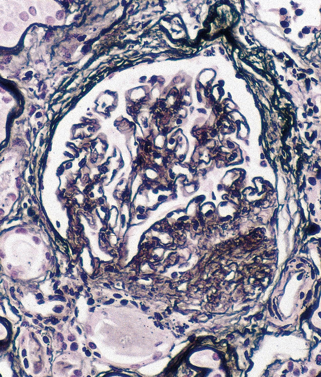 FIG. 3.13, Focal segmental glomerulosclerosis (FSGS).