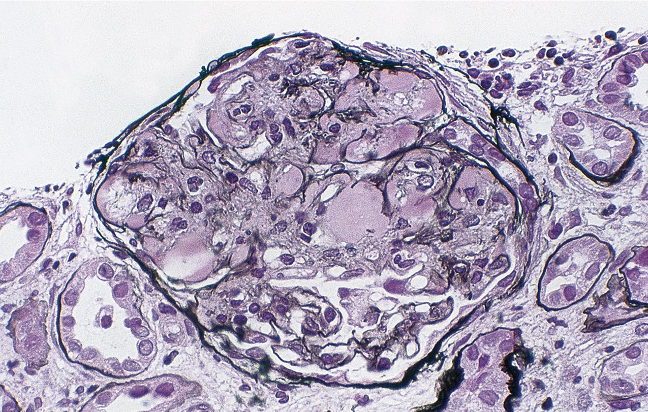 FIG. 3.14, Focal segmental glomerulosclerosis (FSGS).