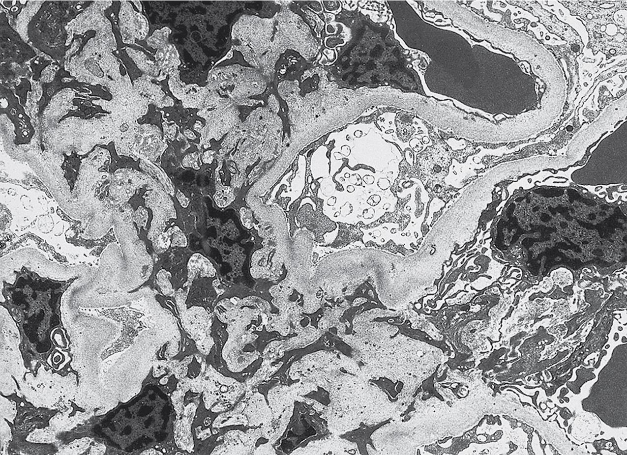 FIG. 3.18, Focal segmental glomerulosclerosis (FSGS).