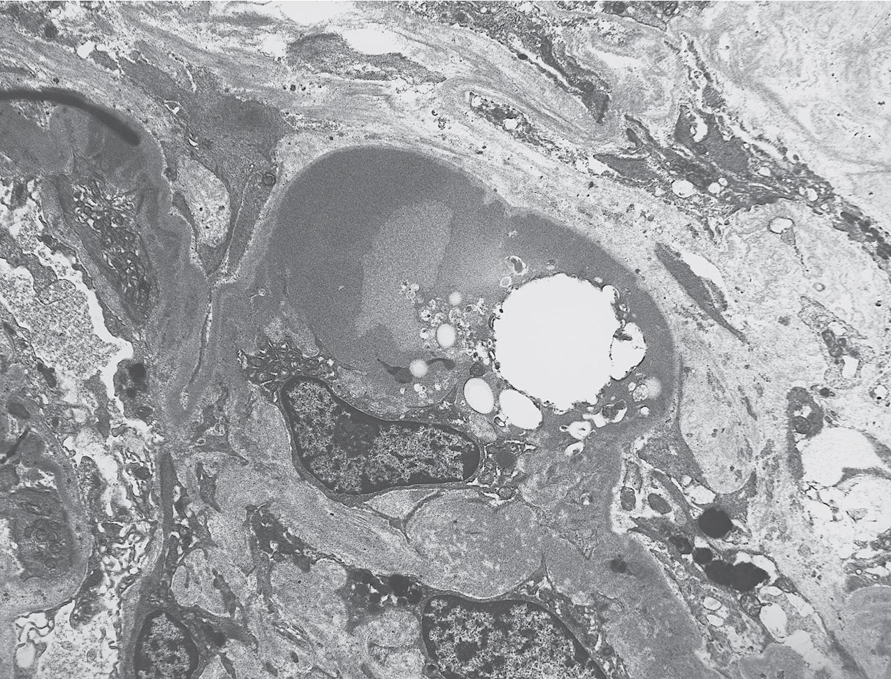 FIG. 3.19, Focal segmental glomerulosclerosis (FSGS).