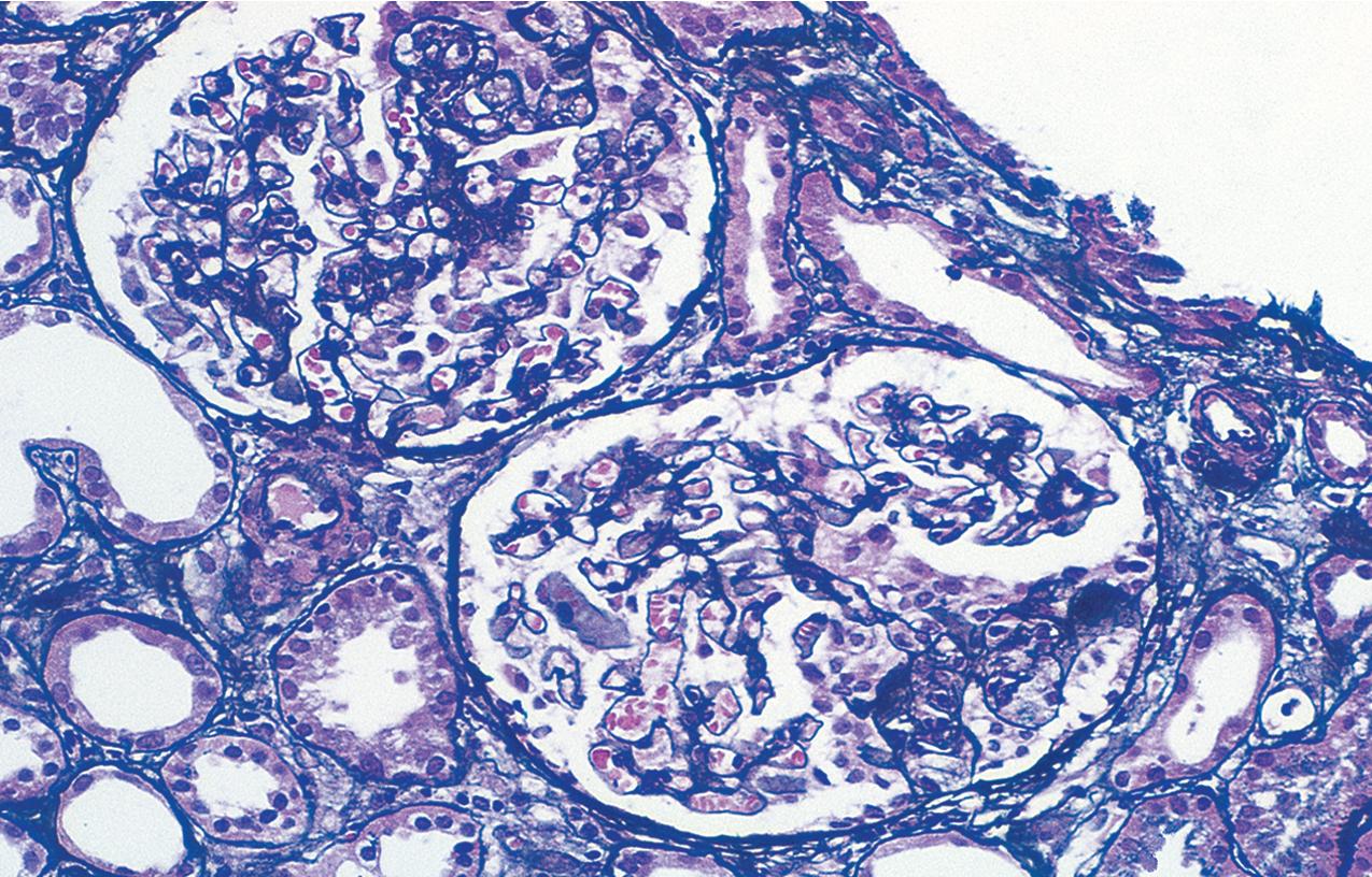 FIG. 3.23, Collapsing glomerulopathy.