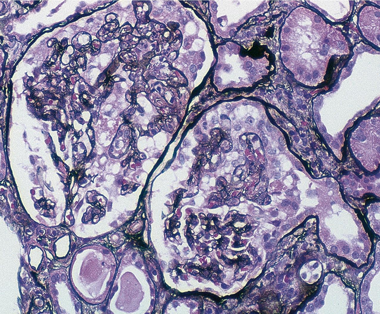 FIG. 3.24, Collapsing glomerulopathy.