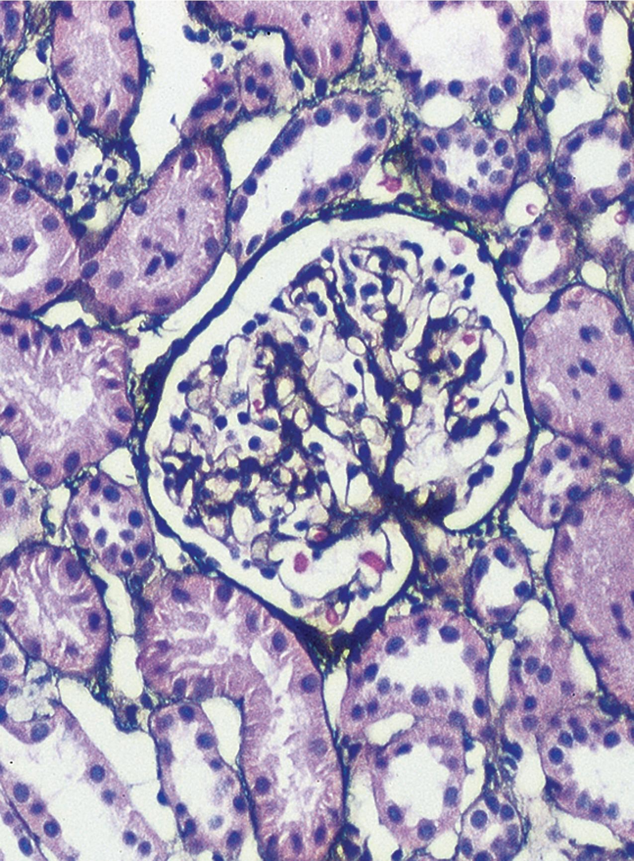 FIG. 3.3, Minimal change disease (MCD).