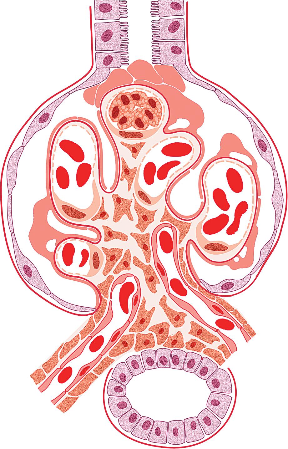 FIG. 3.31, Focal segmental glomerulosclerosis, tip lesion.