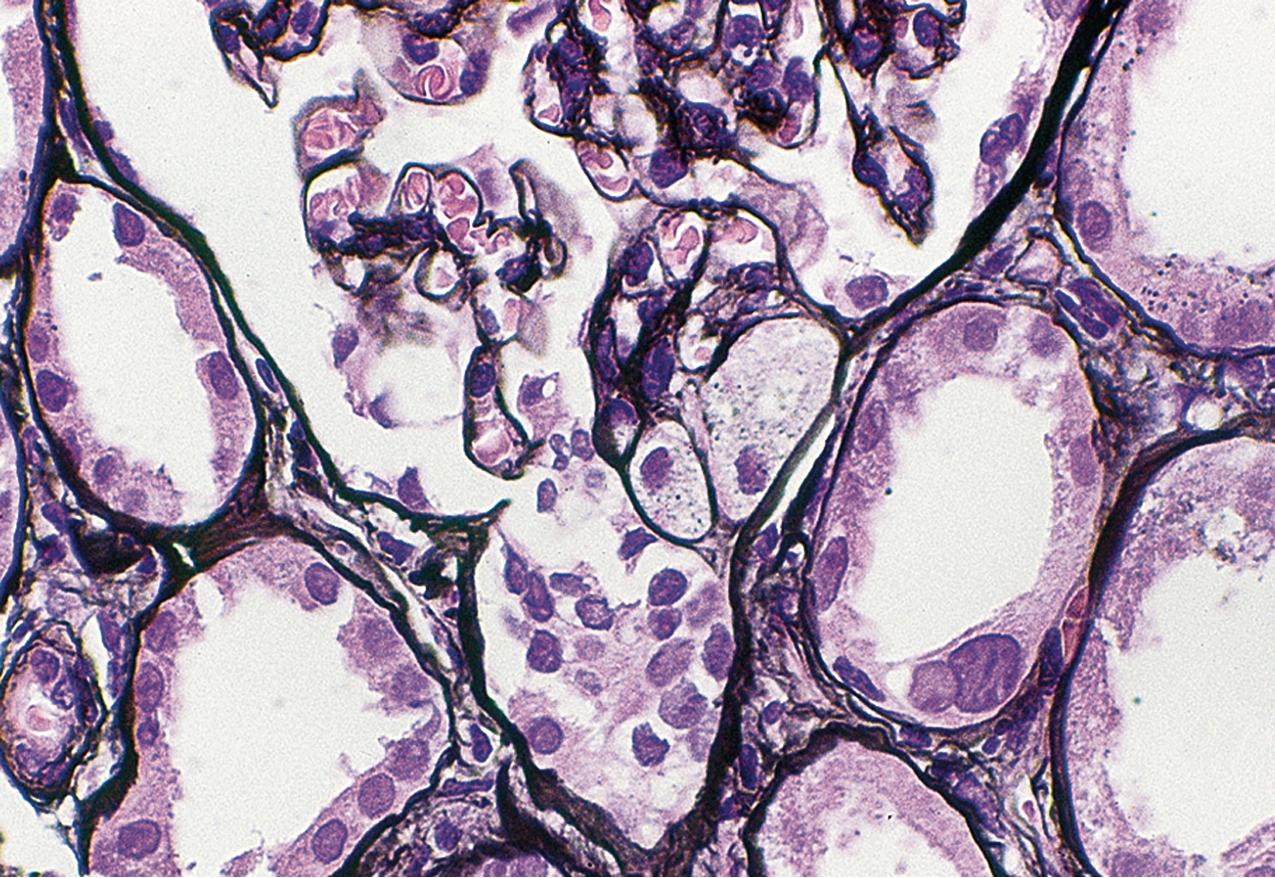 FIG. 3.33, Focal segmental glomerulosclerosis (FSGS), tip lesion.