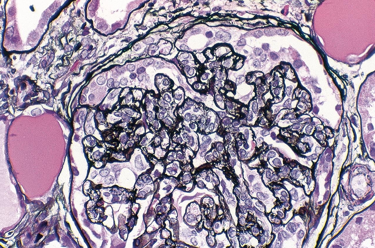 FIG. 3.34, Focal segmental glomerulosclerosis (FSGS), cellular.