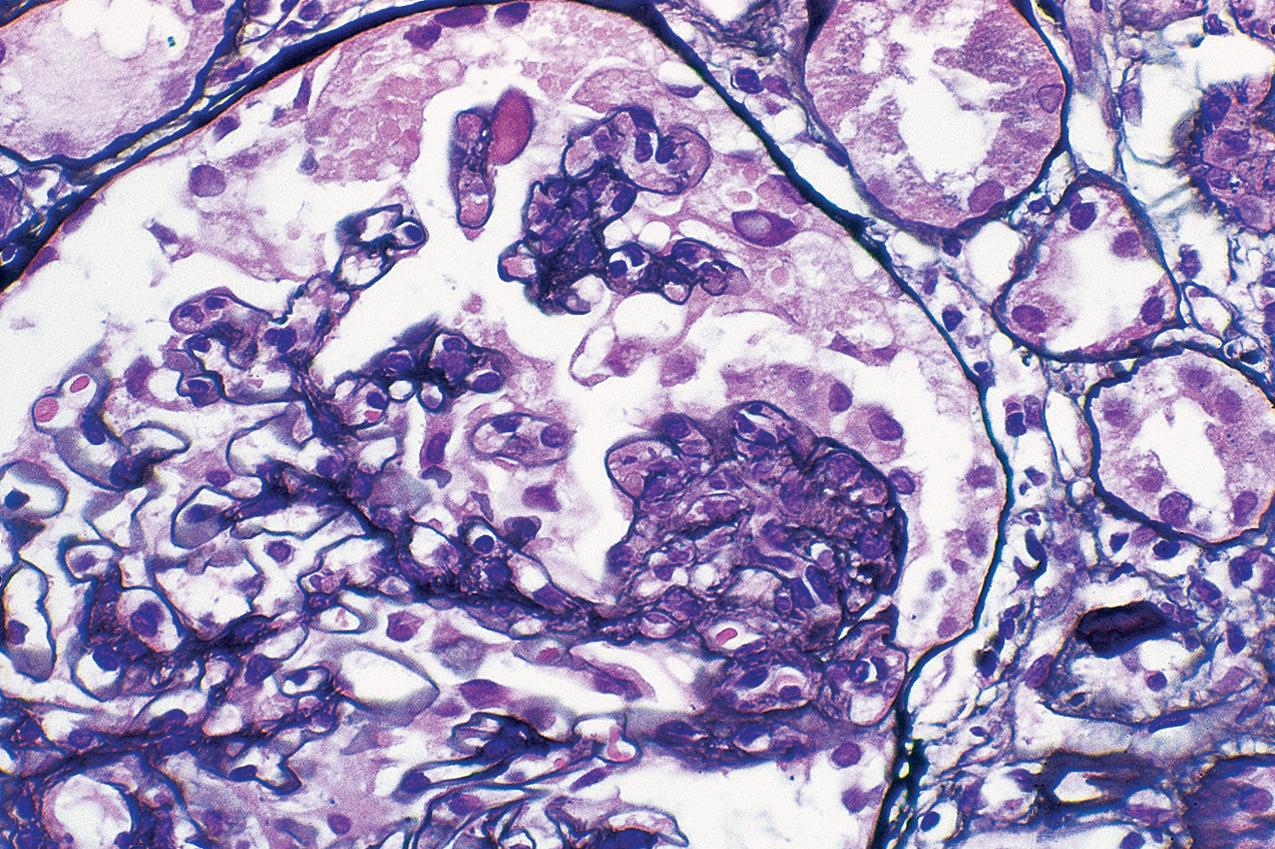 FIG. 3.35, Focal segmental glomerulosclerosis (FSGS), cellular.