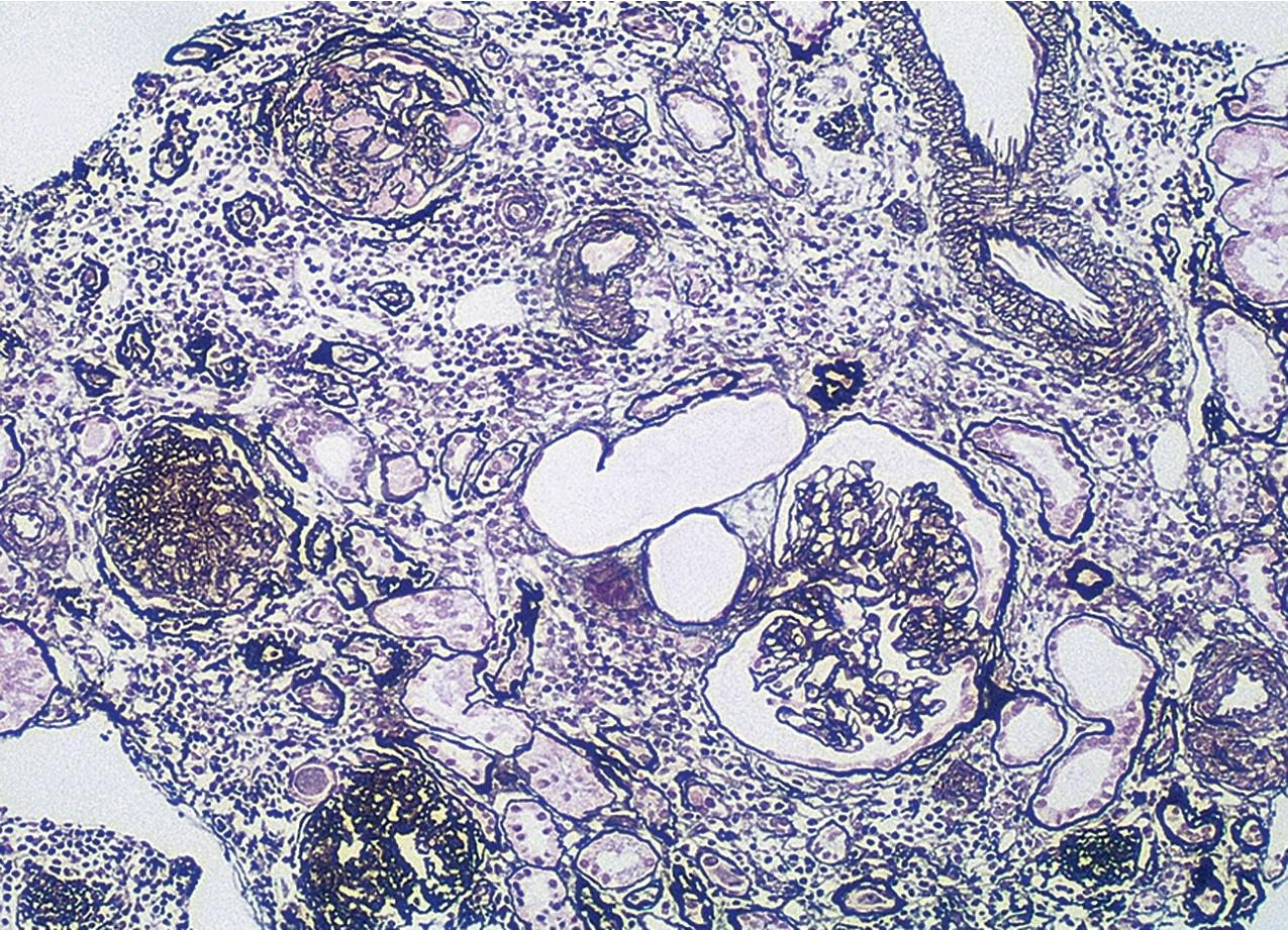 FIG. 3.36, Secondary focal segmental glomerulosclerosis (FSGS).