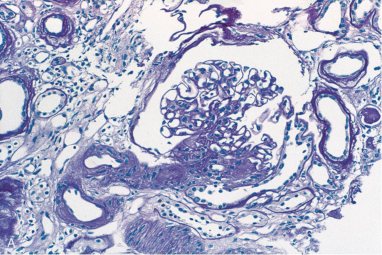 FIG. 3.37, Focal segmental glomerulosclerosis (FSGS), perihilar.