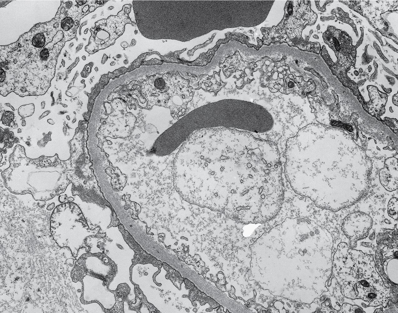 FIG. 3.5, Minimal change disease (MCD).