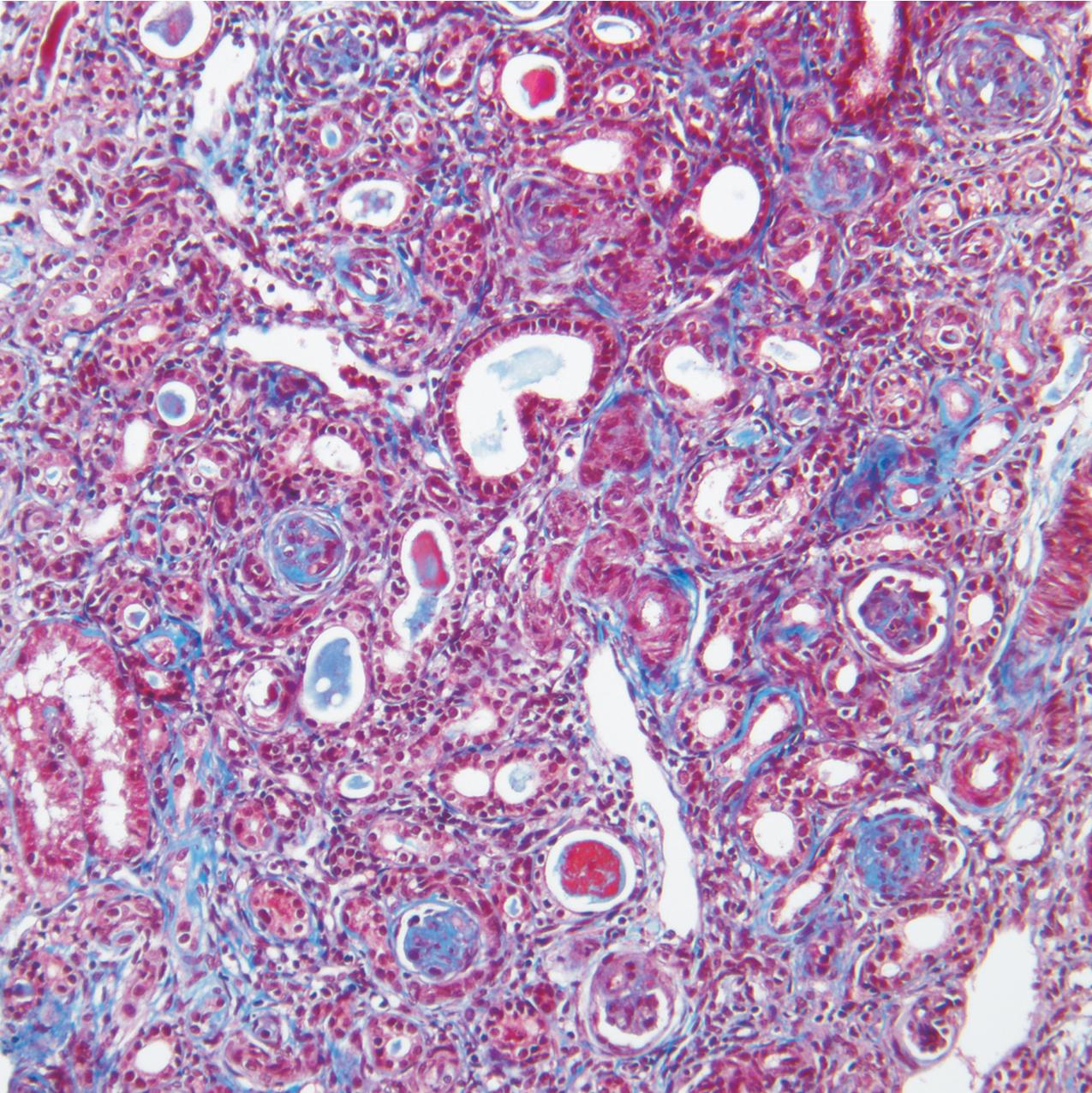 FIG. 3.44, Diffuse mesangial sclerosis.