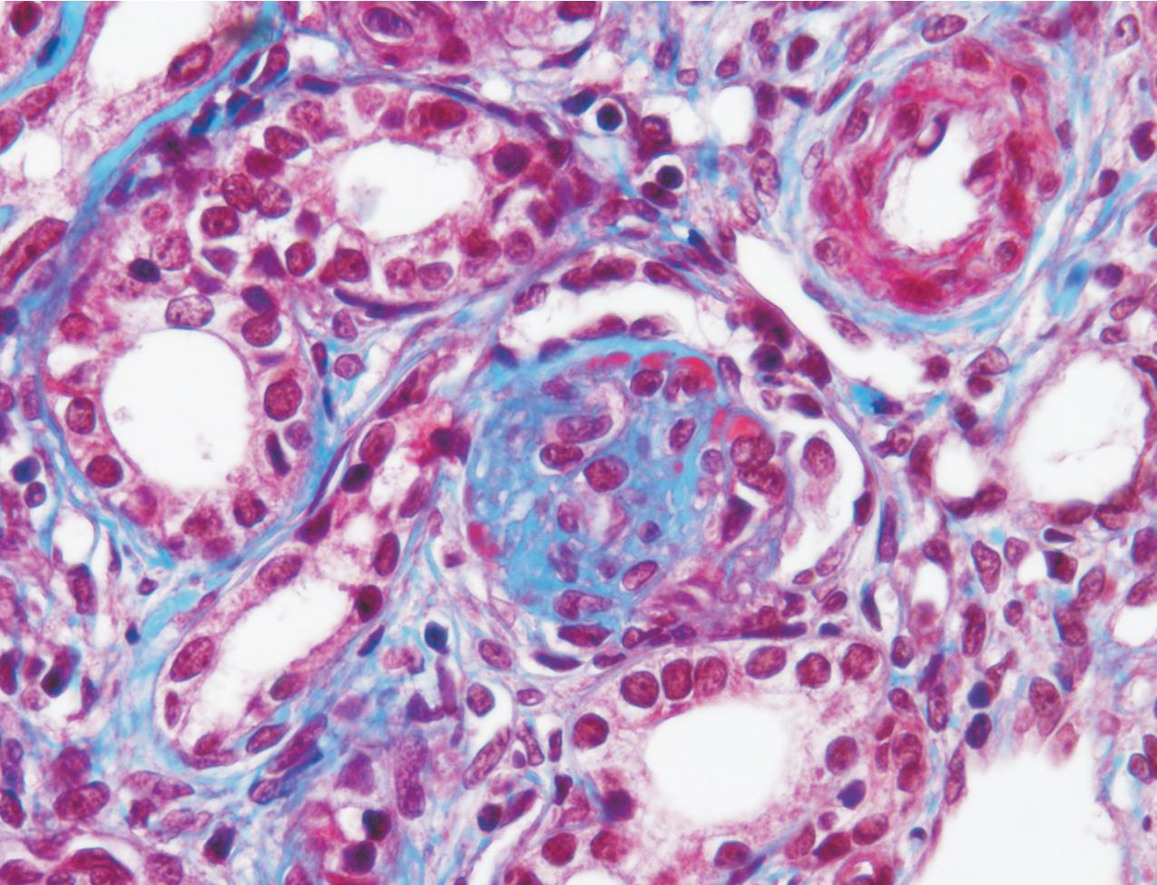 FIG. 3.45, Diffuse mesangial sclerosis with typical appearance of dense expansion of collagenous material within mesangium with minimal increase in mesangial cellularity. There is associated tubular atrophy and interstitial fibrosis (Masson trichrome stain, ×400).