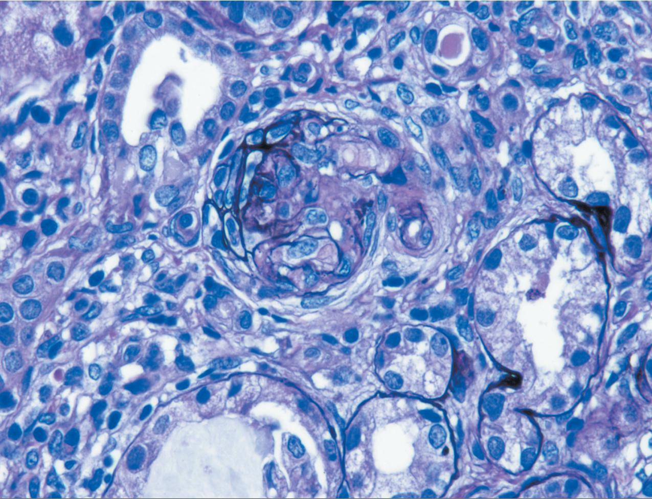 FIG. 3.47, Diffuse mesangial sclerosis with sclerosed expanded mesangial matrix and a fibrocellular crescent but without glomerular basement membrane breaks or fibrinoid necrosis. This type of epithelial cell proliferation may be seen in aggressive sclerosing conditions and is not indicative of a primary necrotizing crescentic process (Jones silver stain, ×400).