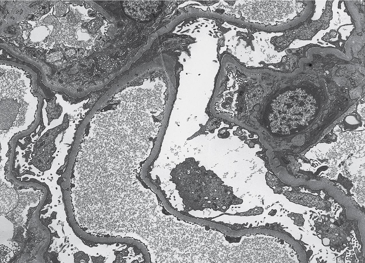 FIG. 3.4, Minimal change disease (MCD).