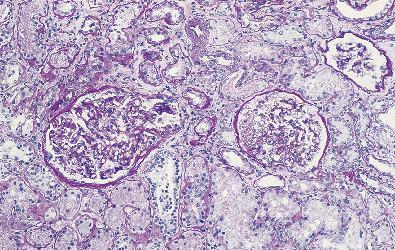 FIG. 3.51, C1q nephropathy.