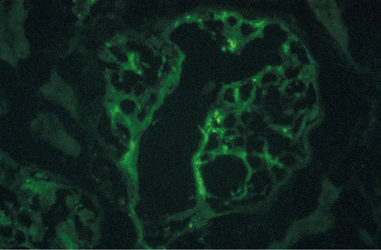 FIG. 3.53, C1q nephropathy.