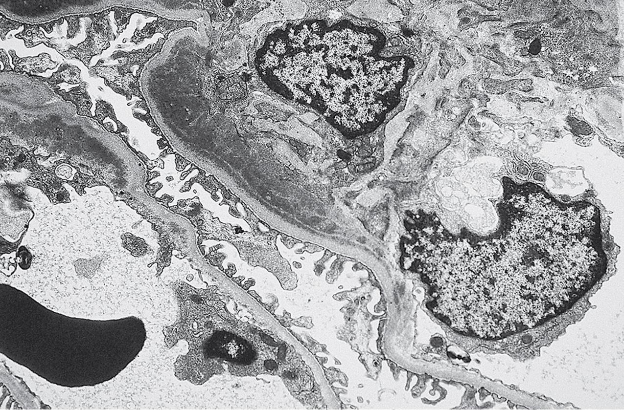 FIG. 3.54, C1q nephropathy.