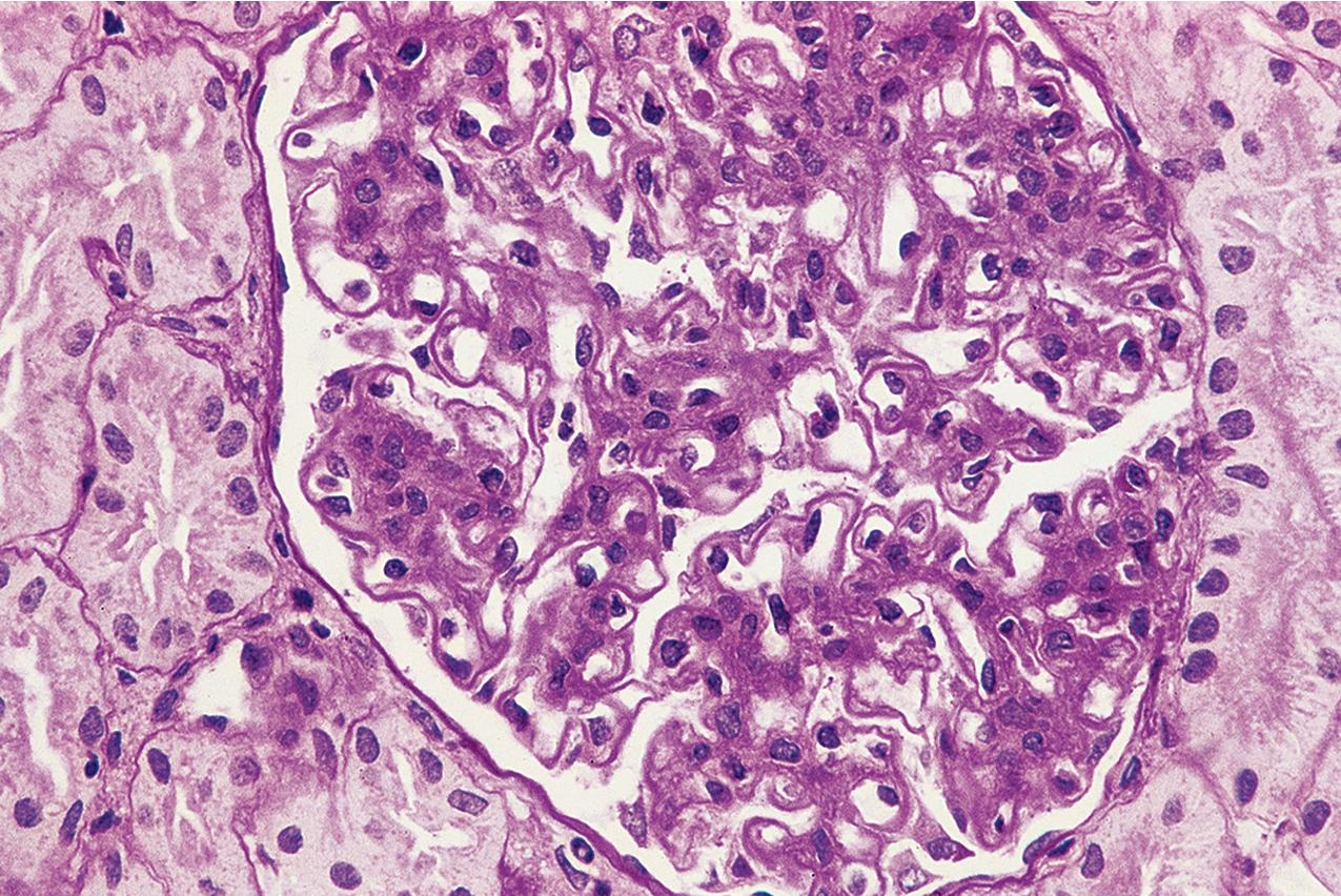 FIG. 3.56, Dense deposit disease can show membranoproliferative features by light microscopy, with diffuse, global mesangial and often endocapillary hypercellularity and frequent glomerular basement membrane double contours. The glomerular basement membrane may in some cases appear more refractile than in idiopathic membranoproliferative glomerulonephritis (hematoxylin and eosin, ×400).