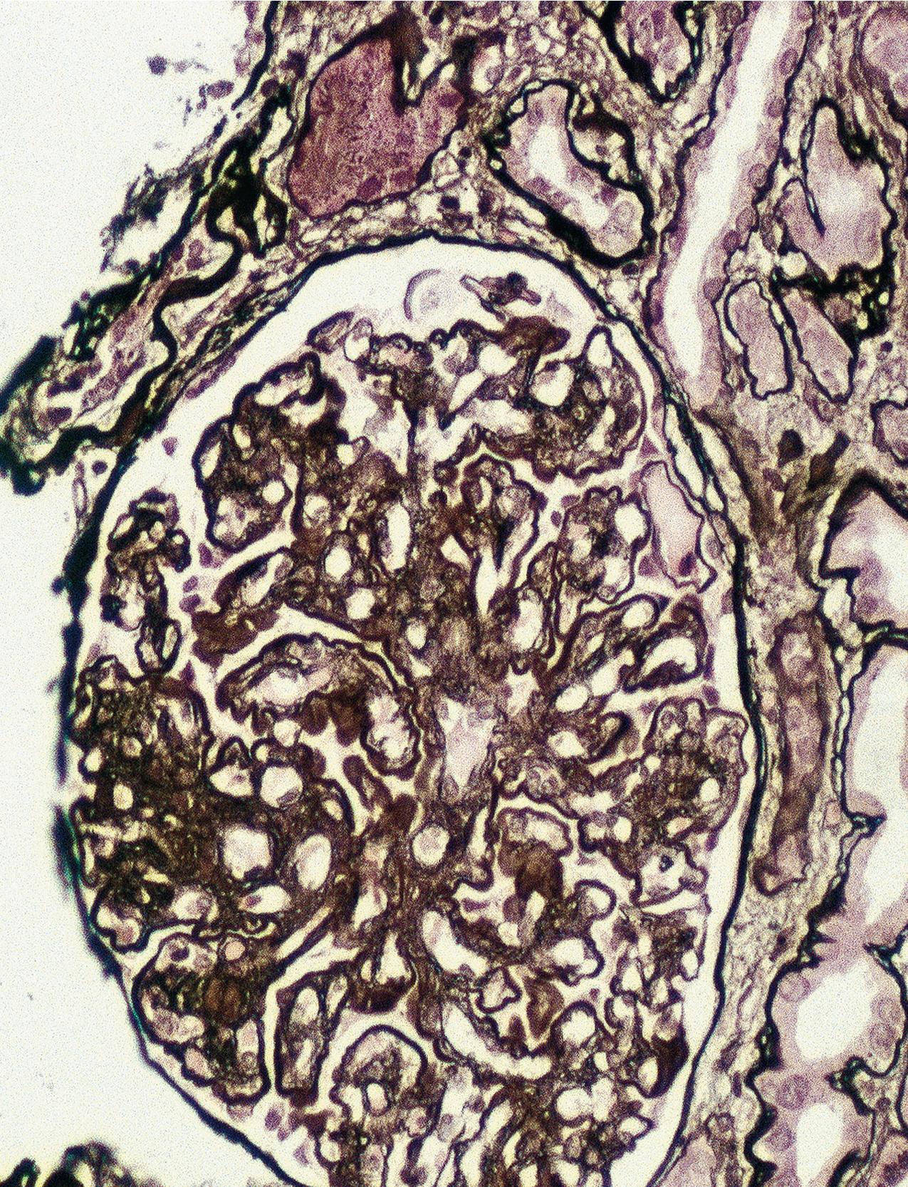 FIG. 3.57, Dense deposit disease.