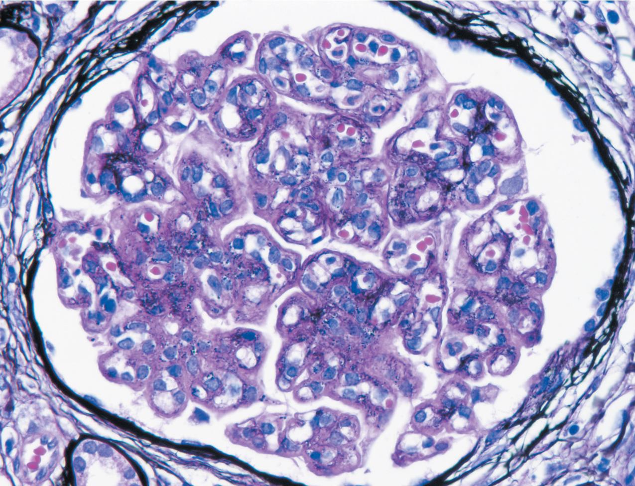 FIG. 3.65, C3 glomerulopathy.