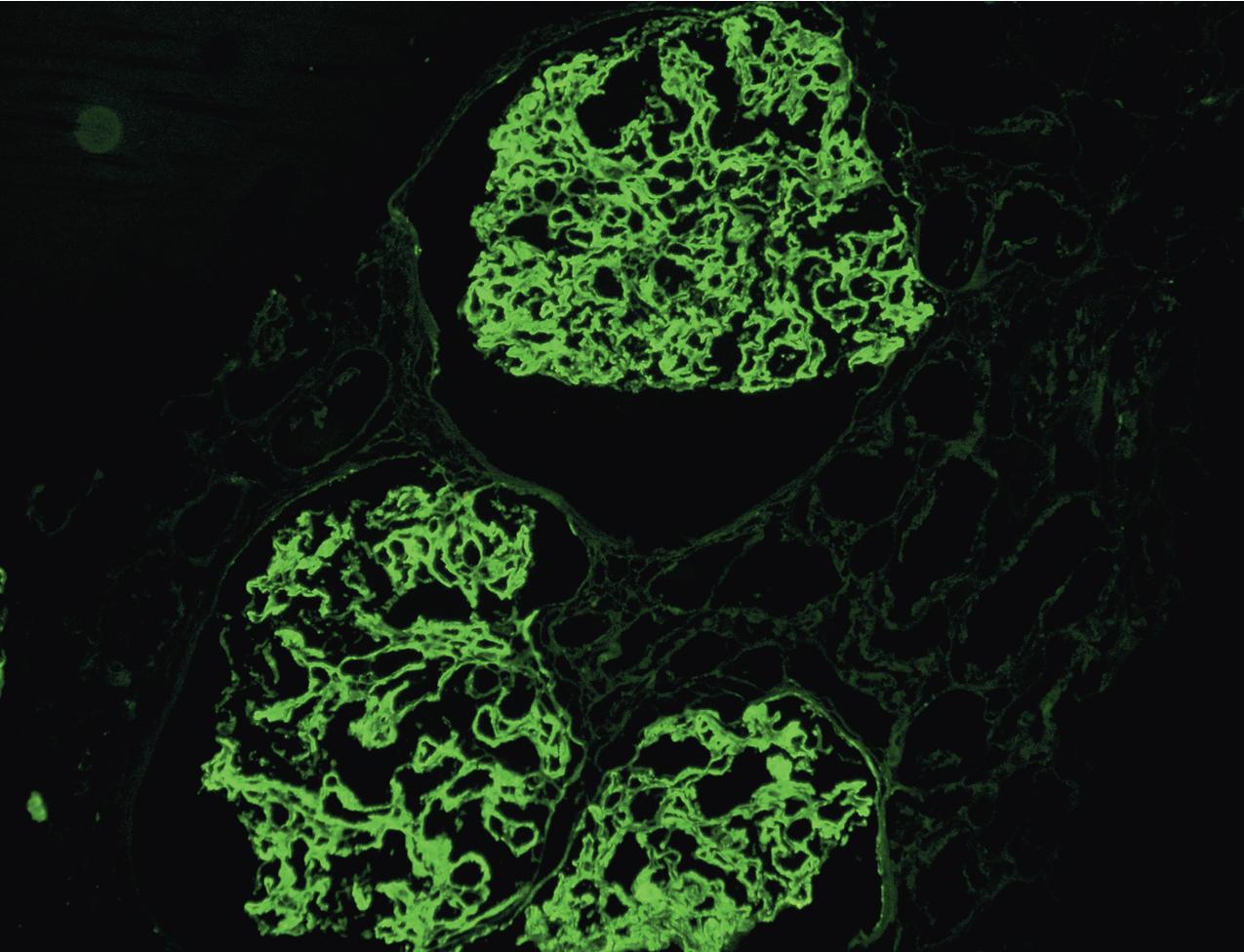 FIG. 3.66, C3 glomerulopathy.