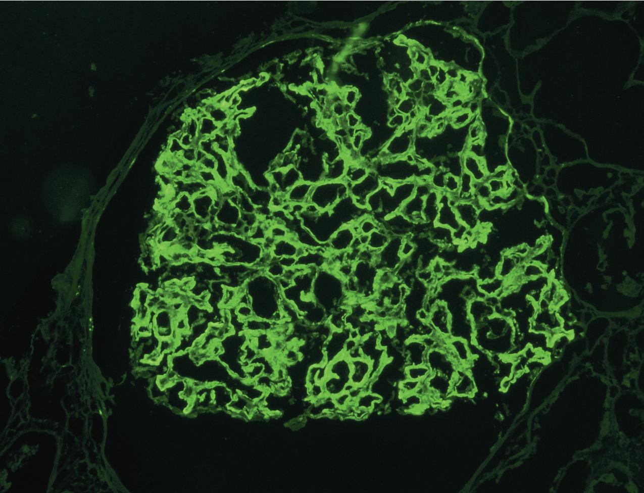 FIG. 3.67, C3 glomerulopathy.