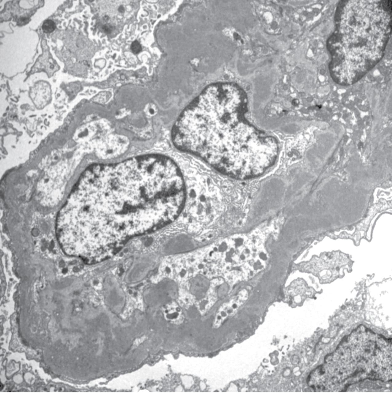 FIG. 3.68, C3 glomerulopathy.