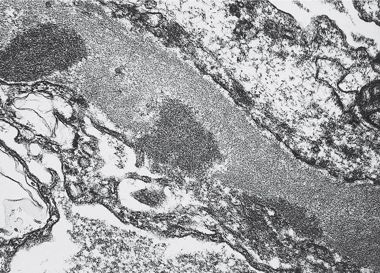 FIG. 3.69, C3 glomerulopathy.