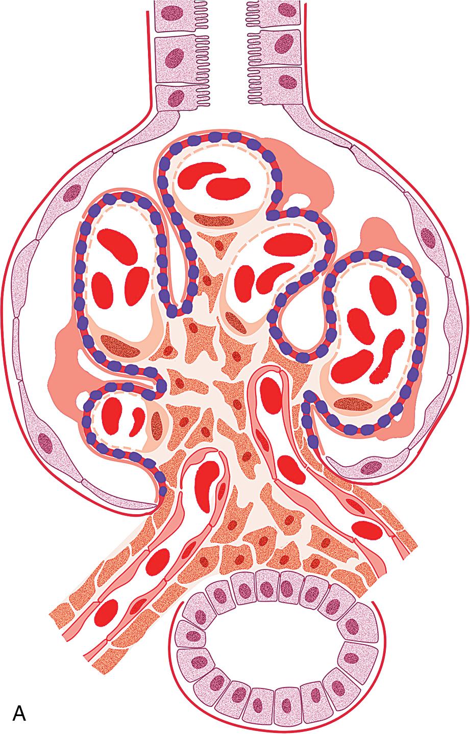 FIG. 3.70, Membranous nephropathy.