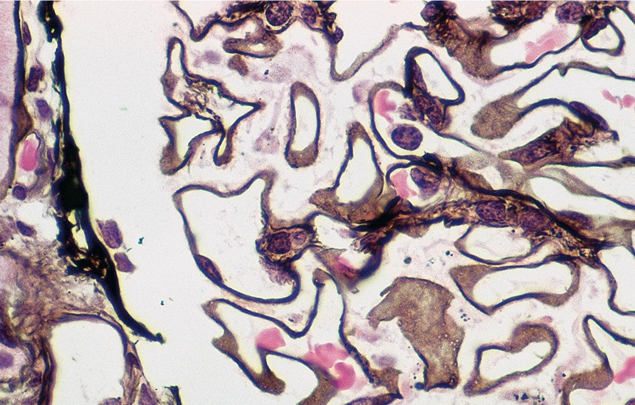 FIG. 3.71, Membranous nephropathy.