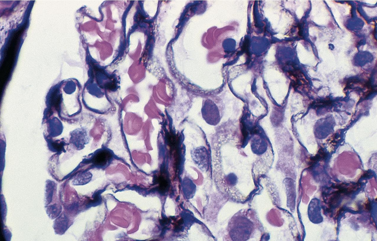 FIG. 3.72, Membranous nephropathy.