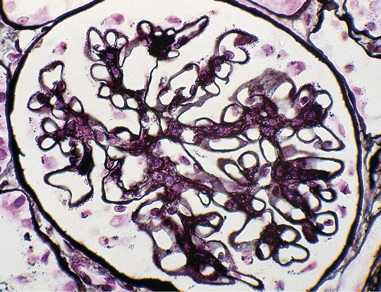 FIG. 3.73, Membranous nephropathy.