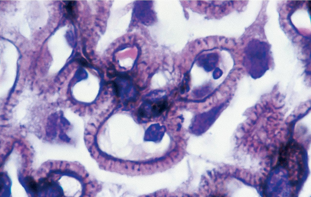 FIG. 3.75, Membranous nephropathy.
