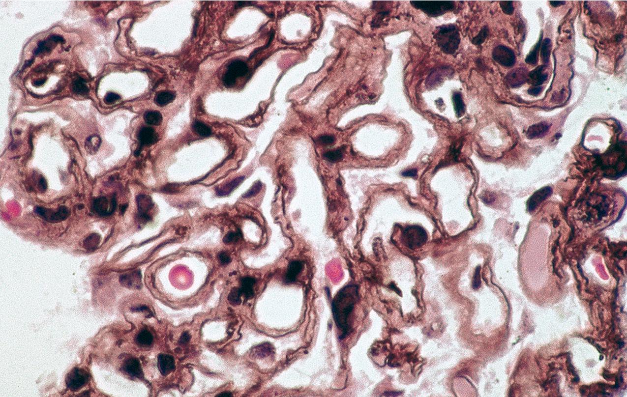 FIG. 3.76, Membranous nephropathy.