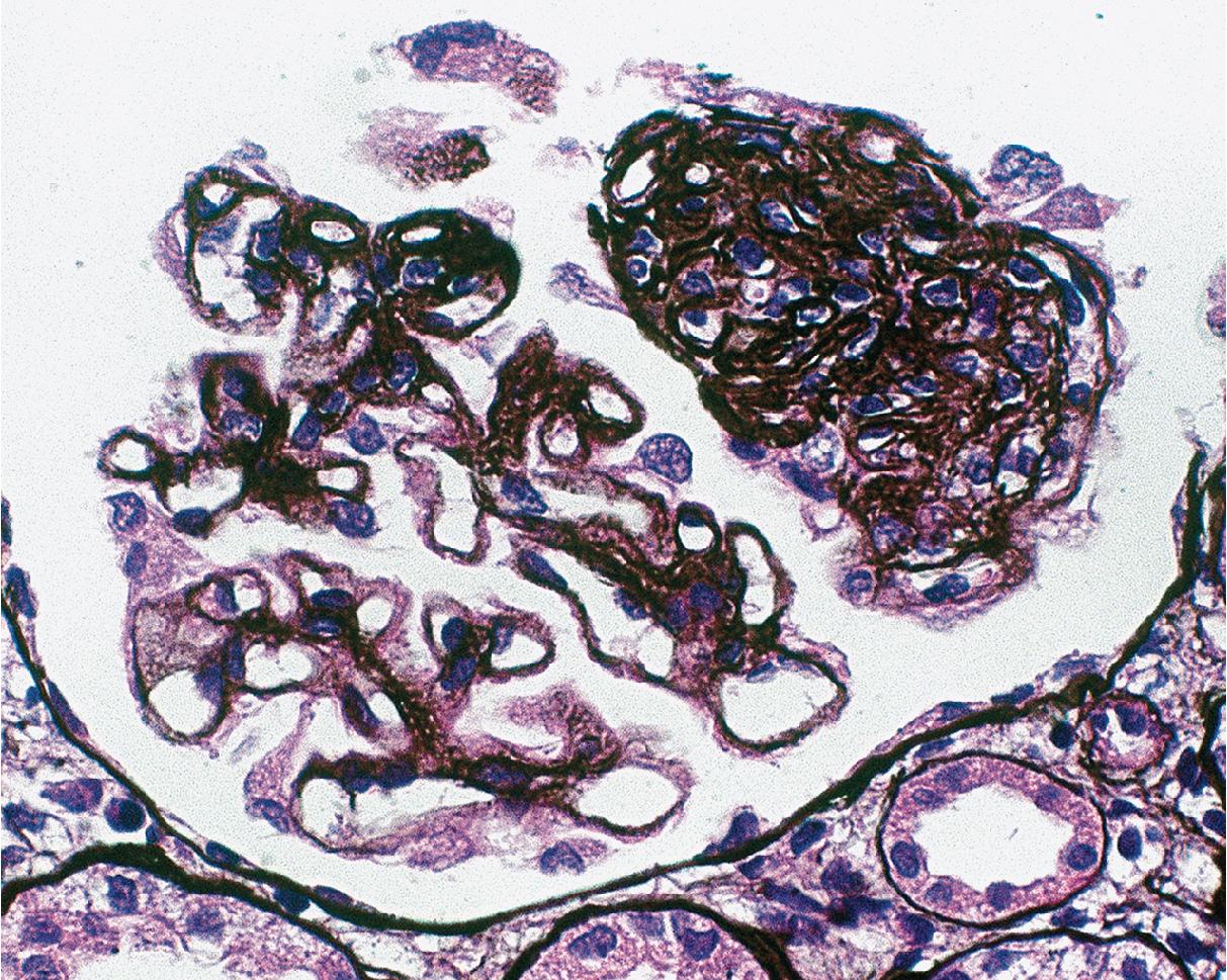 FIG. 3.78, Membranous nephropathy.