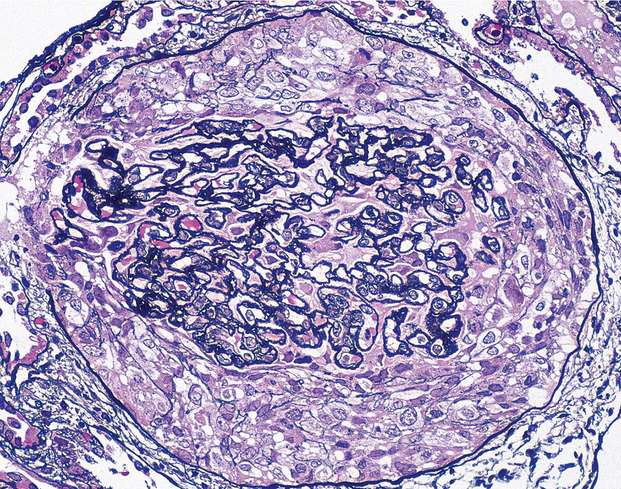 FIG. 3.79, Membranous nephropathy.