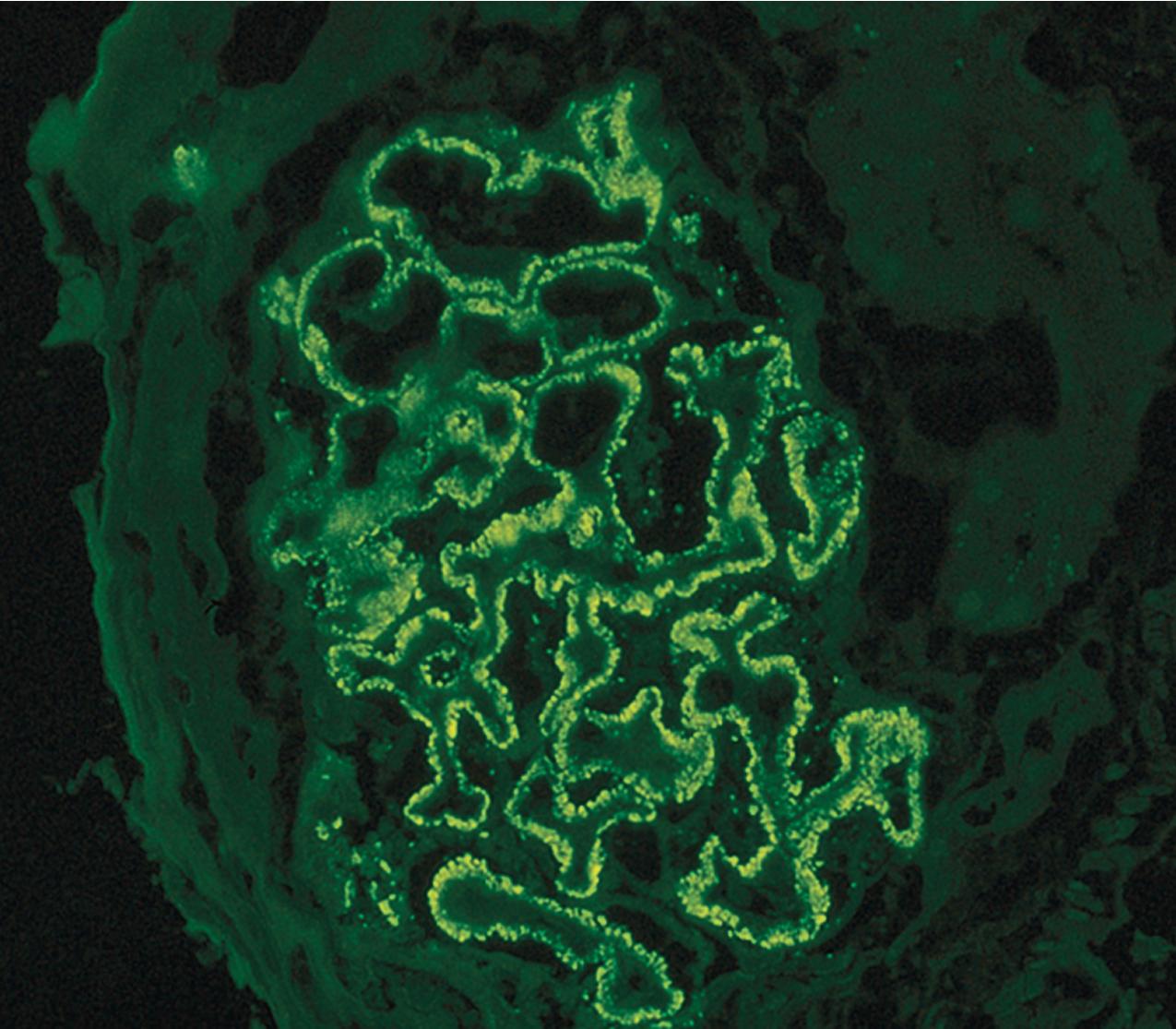 FIG. 3.80, Membranous nephropathy.