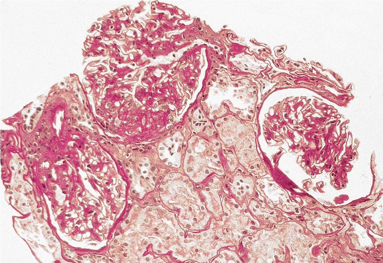 FIG. 3.8, Focal segmental glomerulosclerosis (FSGS).