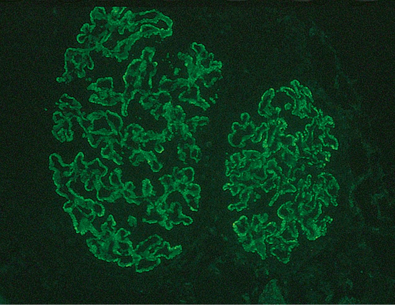 FIG. 3.81, Membranous nephropathy.