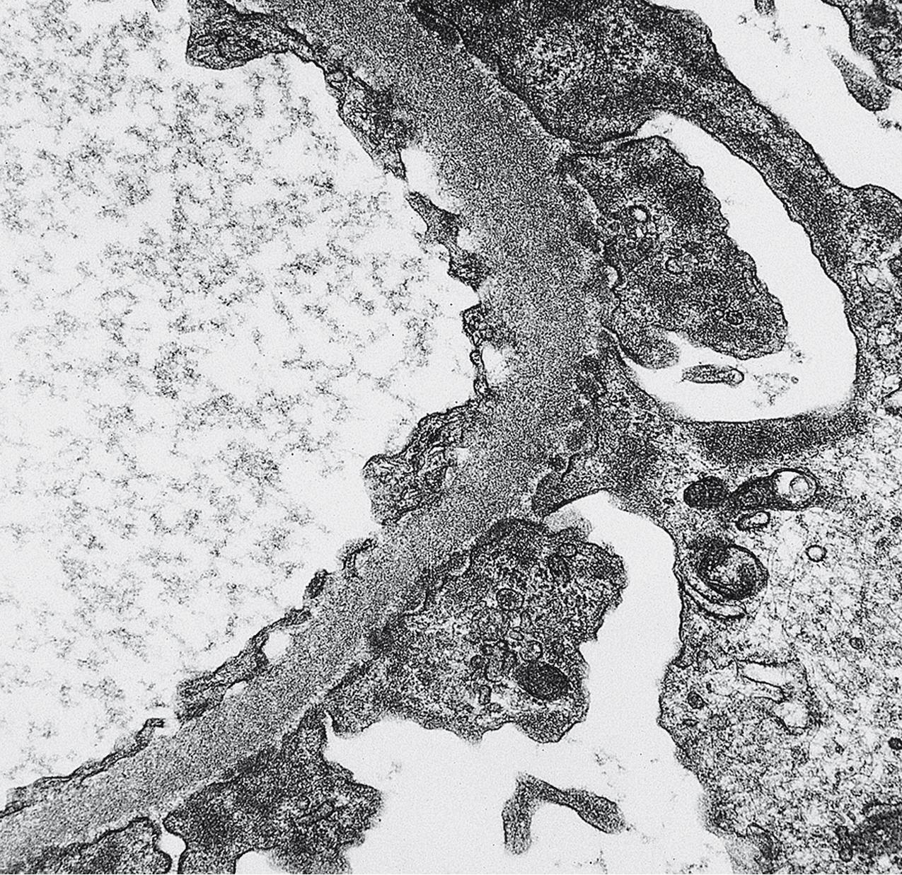 FIG. 3.83, Membranous nephropathy.